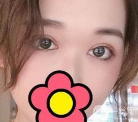 山大二院整形科2020價(jià)格表公布,附雙眼皮案例術(shù)后*果圖