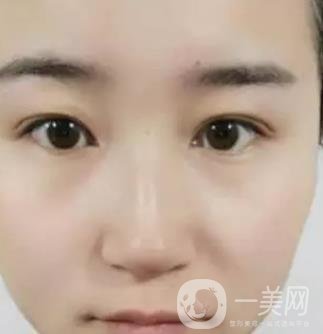 長海醫(yī)院邢新做雙眼皮修復好嗎？價格表及案例詳情一覽