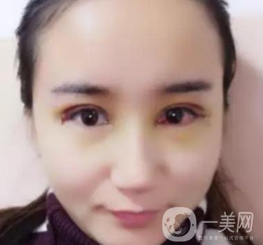 長海醫(yī)院邢新做雙眼皮修復好嗎？價格表及案例詳情一覽