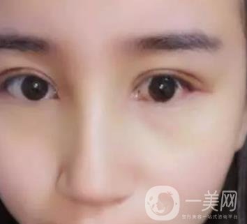 長海醫(yī)院邢新做雙眼皮修復好嗎？價格表及案例詳情一覽