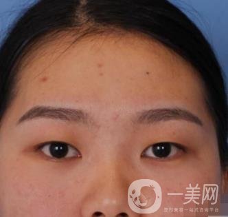 河北省人民醫(yī)院做雙眼皮咋樣?價格表一覽