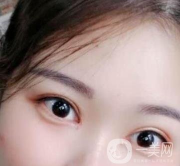 河北省人民醫(yī)院做雙眼皮咋樣?價格表一覽