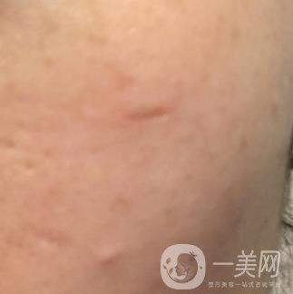 南通大學(xué)附屬醫(yī)院整形科價(jià)格表，附激光去疤案例