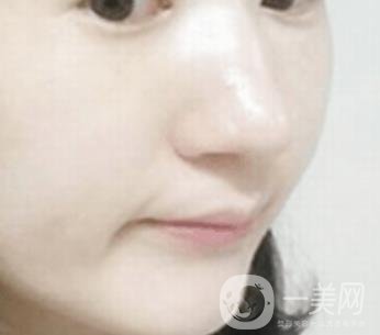 南通大學(xué)附屬醫(yī)院整形科價(jià)格表，附激光去疤案例