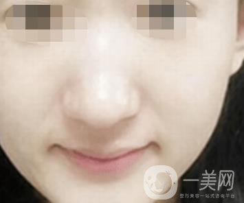 南通大學(xué)附屬醫(yī)院整形科價(jià)格表，附激光去疤案例