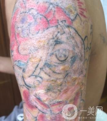 徐州市中心醫(yī)院整形科價(jià)格表，附洗紋身案例