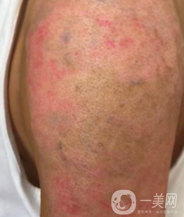 徐州市中心醫(yī)院整形科價(jià)格表，附洗紋身案例