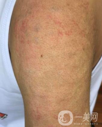 徐州市中心醫(yī)院整形科價(jià)格表，附洗紋身案例