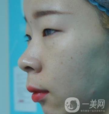 北京彤美醫(yī)療整形醫(yī)院價(jià)格表，附桂行軍雙眼皮術(shù)后*果一覽