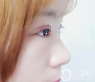 北京彤美醫(yī)療整形醫(yī)院價(jià)格表，附桂行軍雙眼皮術(shù)后*果一覽