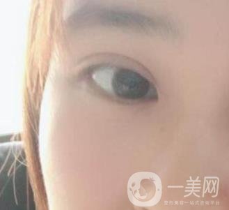 北京韓勛雙眼皮修復怎么樣？附整形價格表一覽
