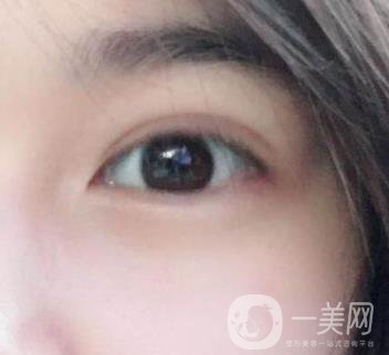 北京韓勛雙眼皮修復怎么樣？附整形價格表一覽