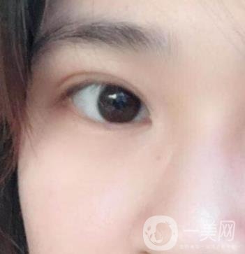 北京韓勛雙眼皮修復怎么樣？附整形價格表一覽