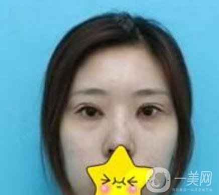 濟寧附屬醫(yī)院做雙眼皮多少錢？附真實案例及整形價格表