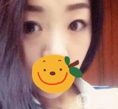 昆明市第一人民醫(yī)院雙眼皮多少錢？附案例及2020全新整形價格表