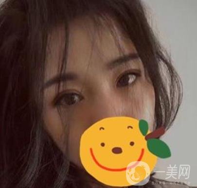 昆明市第一人民醫(yī)院雙眼皮多少錢？附案例及2020全新整形價格表