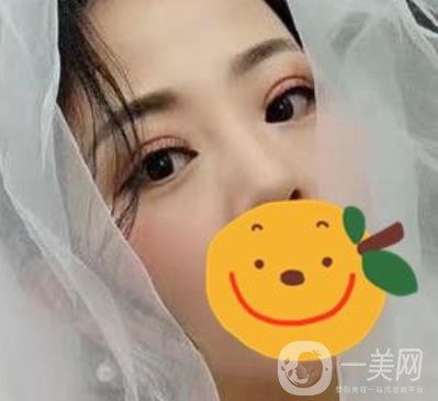 昆明市第一人民醫(yī)院雙眼皮多少錢？附案例及2020全新整形價格表