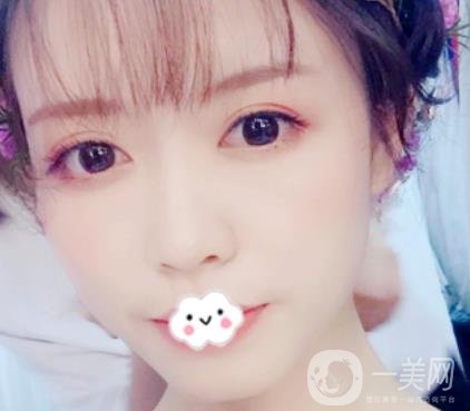 劉波醫(yī)生隆鼻修復