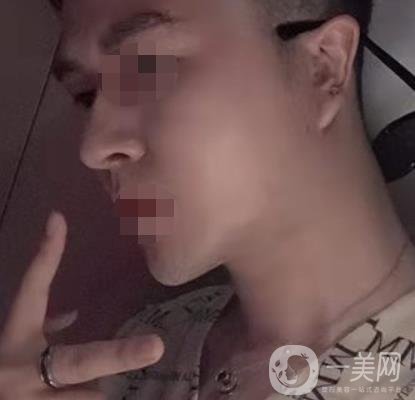 邱健欽醫(yī)生隆鼻