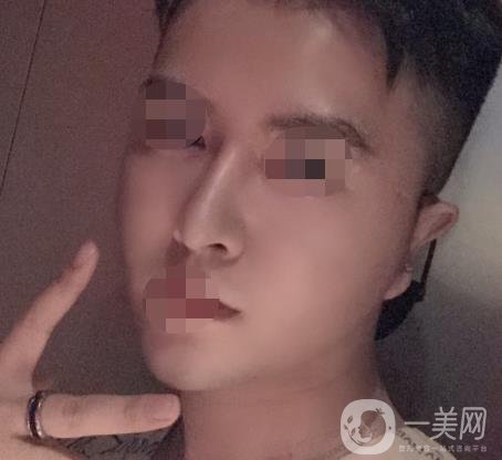 邱健欽醫(yī)生隆鼻