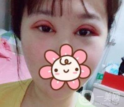 上海華美楊亞益做眼睛多少錢？?jī)r(jià)格表及案例詳情