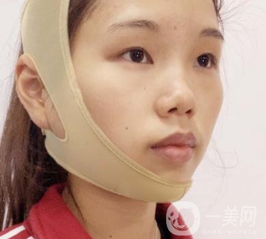 上海時(shí)光醫(yī)院何晉龍磨骨怎么樣？價(jià)格表及術(shù)后*果分享