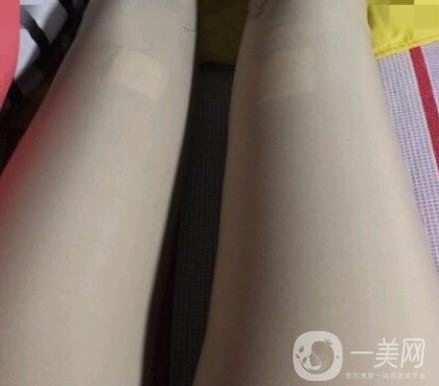 中南大學第一醫(yī)院整形美容科價格表*新發(fā)布,附全身吸脂*果分享