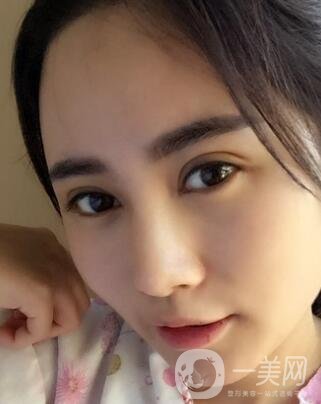 北京處整形外科價格(目)表2020一覽，附雙眼皮案例