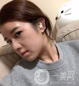 鹽城東方女子整形醫(yī)院價格表明細(xì)，附隆鼻案例