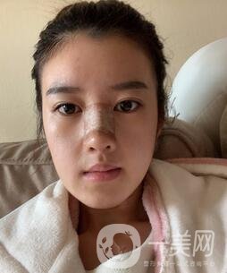 鹽城東方女子整形醫(yī)院價格表明細(xì)，附隆鼻案例