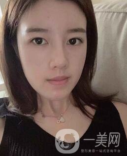 鹽城東方女子整形醫(yī)院價格表明細(xì)，附隆鼻案例