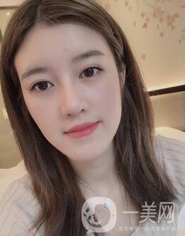 鹽城東方女子整形醫(yī)院價格表明細(xì)，附隆鼻案例