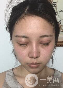 蘭大二院整形外科價格表2020，附雙眼皮整形日記