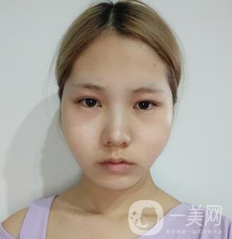 運(yùn)城中心醫(yī)院整形外科價(jià)格表，附顴骨降低案例分享