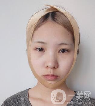 運(yùn)城中心醫(yī)院整形外科價(jià)格表，附顴骨降低案例分享