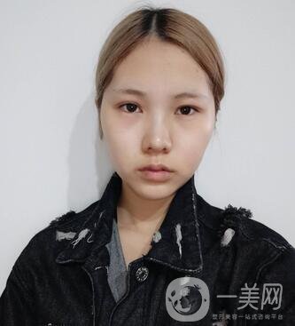 運(yùn)城中心醫(yī)院整形外科價(jià)格表，附顴骨降低案例分享