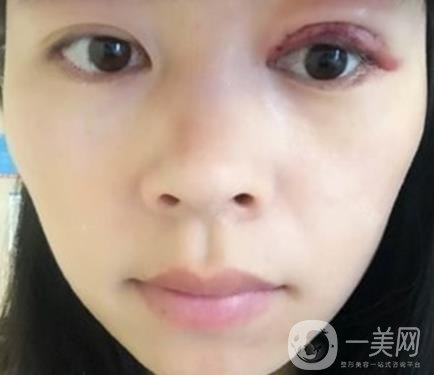 河南省立眼科醫(yī)院做上臉下垂怎么樣?價格表和真人*果圖展示