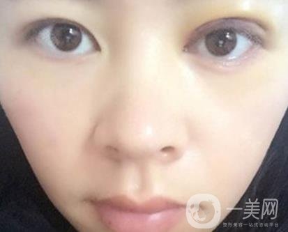 河南省立眼科醫(yī)院做上臉下垂怎么樣?價格表和真人*果圖展示