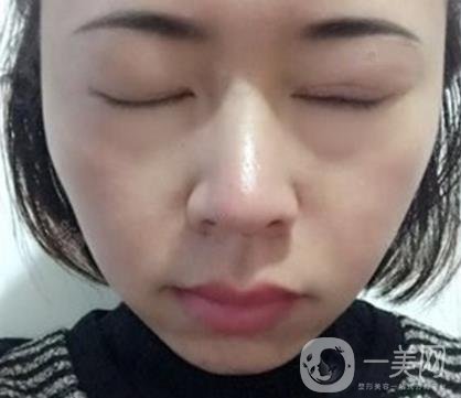 河南省立眼科醫(yī)院做上臉下垂怎么樣?價格表和真人*果圖展示