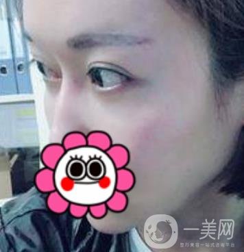 北京友誼醫(yī)院整形科祛眼袋*果好不好？2020年價格價目收費曝光啦