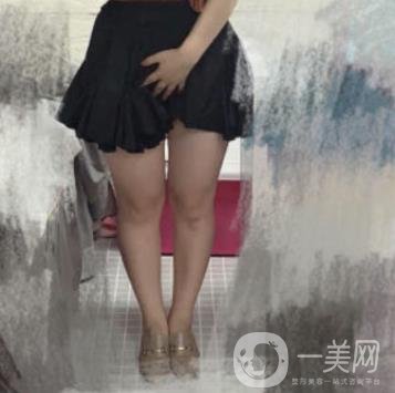 南京檸檬吸脂怎么樣?大腿吸脂案例及整形價格表預(yù)覽