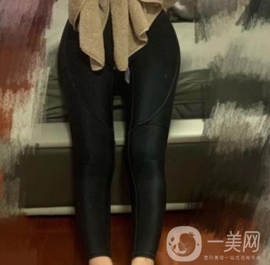 南京檸檬吸脂怎么樣?大腿吸脂案例及整形價格表預(yù)覽