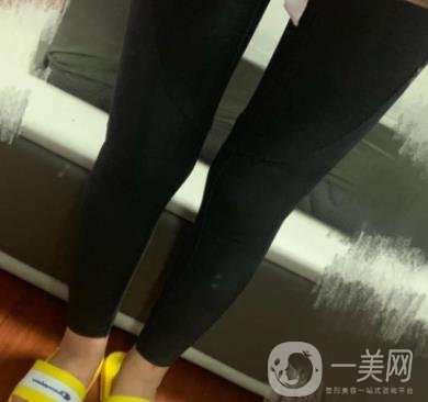 南京檸檬吸脂怎么樣?大腿吸脂案例及整形價格表預(yù)覽