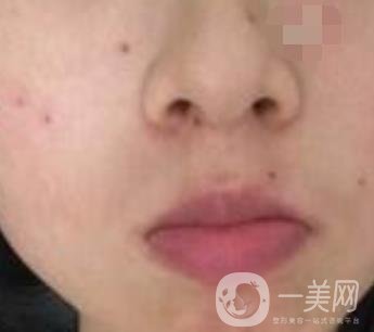 青醫(yī)附院激光去痣多少錢?案例及整形價(jià)格表分享