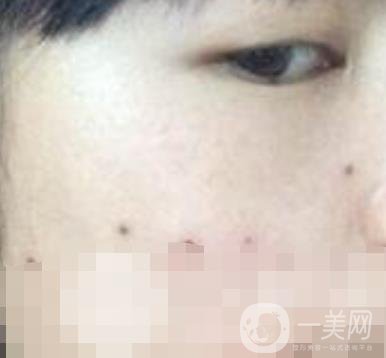 青醫(yī)附院激光去痣多少錢?案例及整形價(jià)格表分享