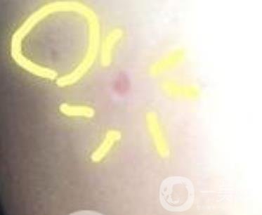 青醫(yī)附院激光去痣多少錢?案例及整形價(jià)格表分享