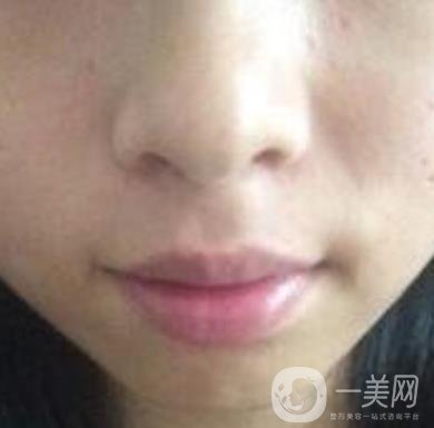 青醫(yī)附院激光去痣多少錢?案例及整形價(jià)格表分享