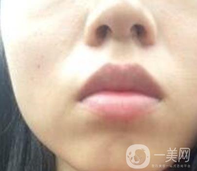 青醫(yī)附院激光去痣多少錢?案例及整形價(jià)格表分享