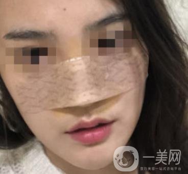 深圳人民醫(yī)院整形外科價目表，附隆鼻案例