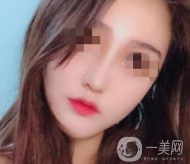 深圳人民醫(yī)院整形外科價目表，附隆鼻案例